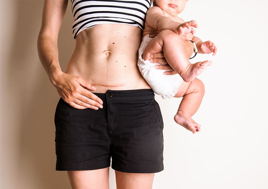 woman showing her c-section scar